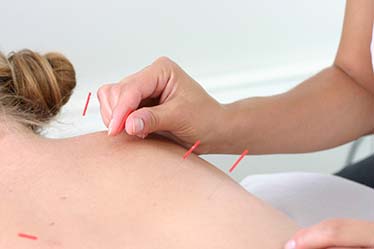 Cairns Traditional Acupuncture